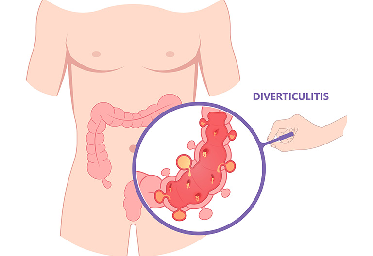 大腸憩室症とは
